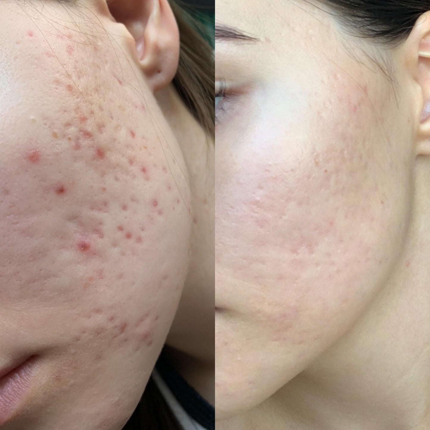 DoliSkin™ High Frequency Therapy