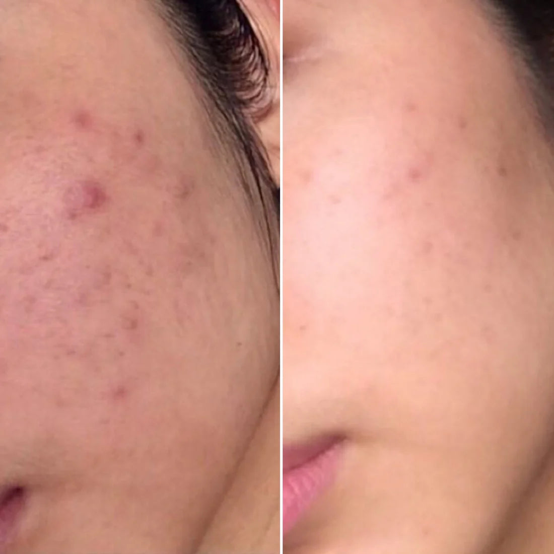 DoliSkin™ High Frequency Therapy