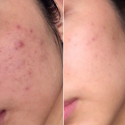 DoliSkin™ High Frequency Therapy